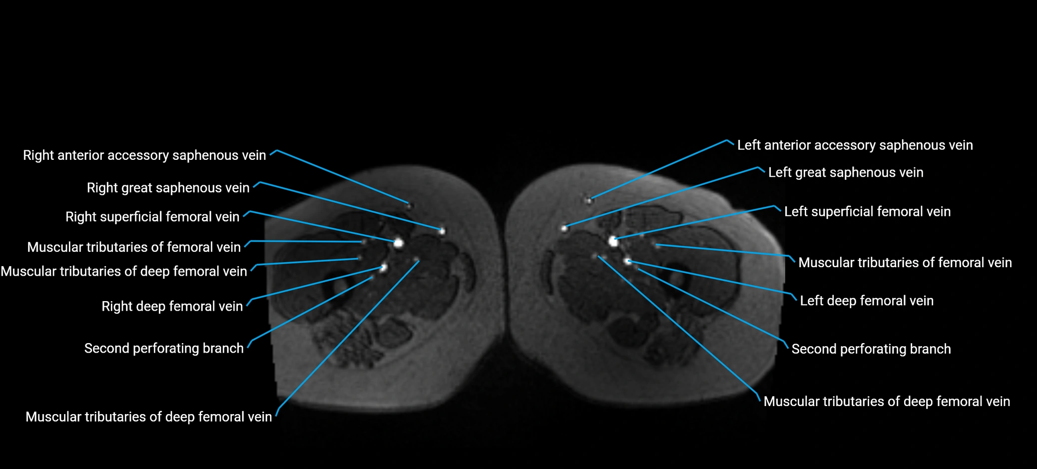 MRV abdomen pelvis & lower limb axial cross sectional anatomy labelled MRI image 230 (1).webp